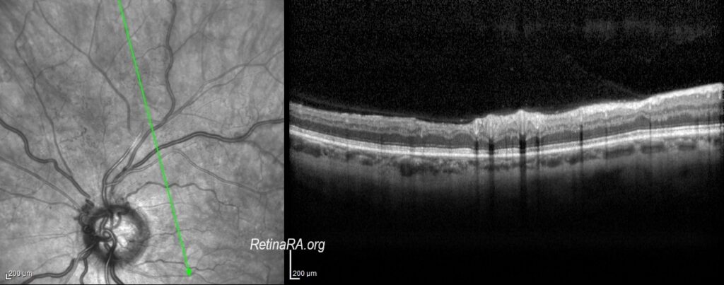 Optociliary-shunt-vessels10