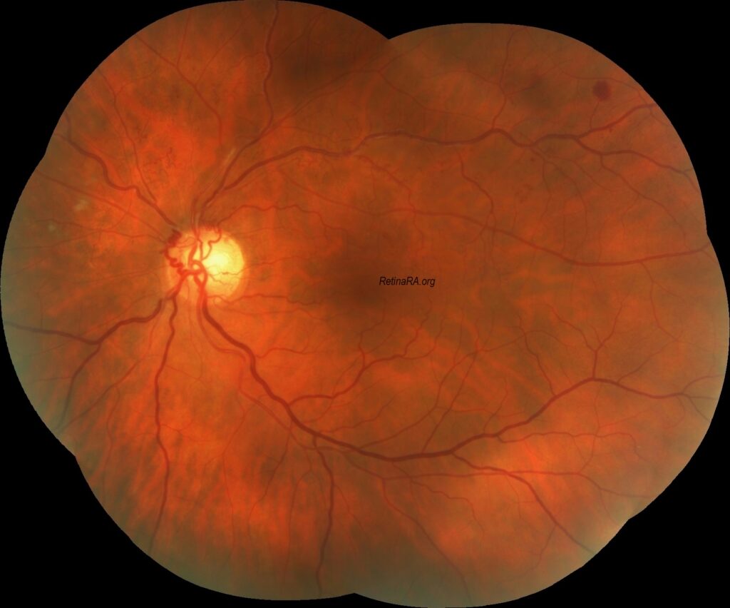Optociliary-shunt-vessels2