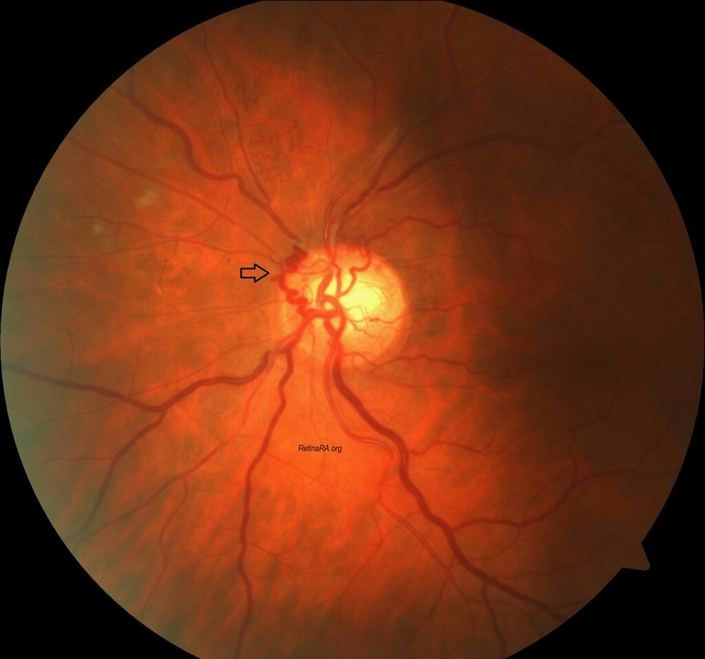 Optociliary-shunt-vessels3