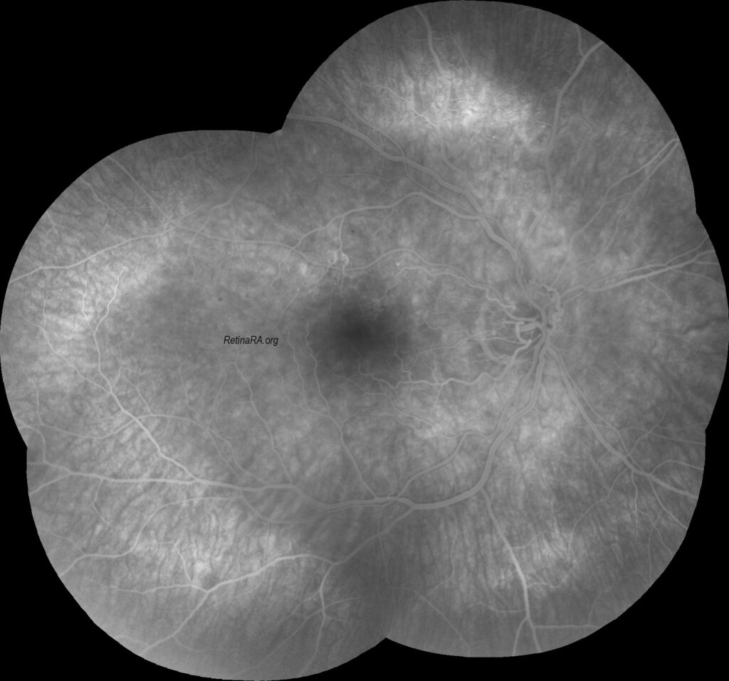 Optociliary-shunt-vessels5