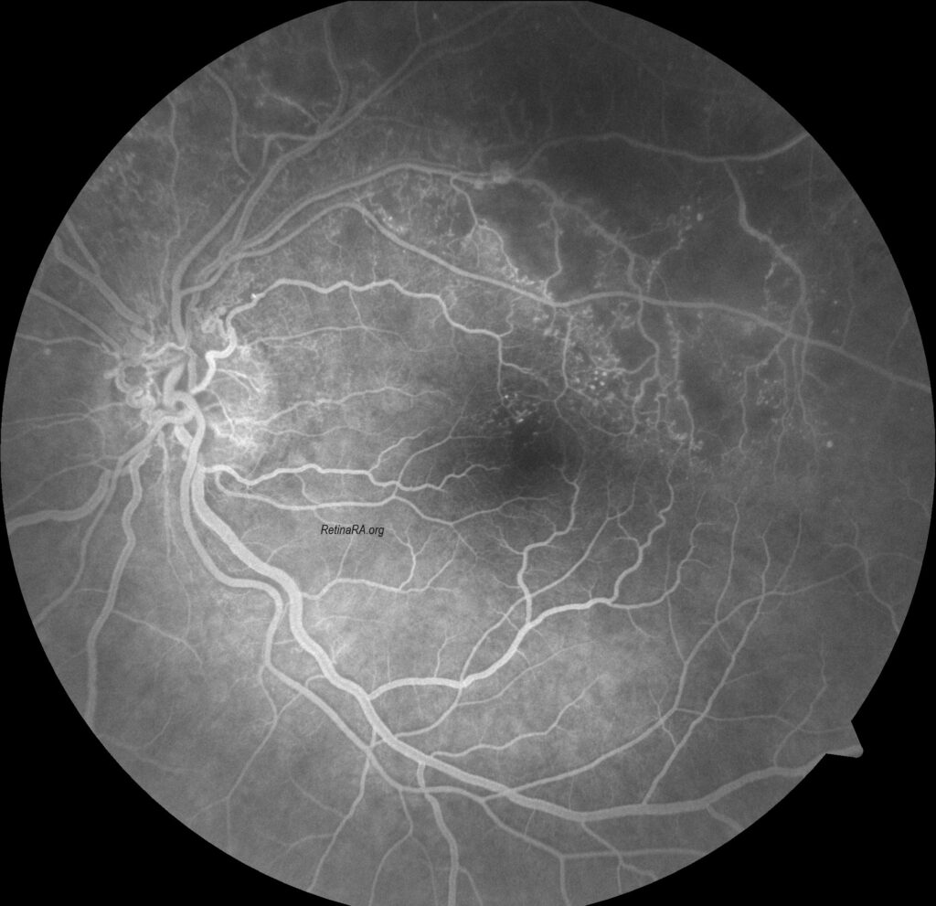 Optociliary-shunt-vessels6