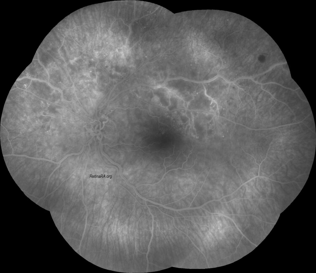 Optociliary-shunt-vessels7