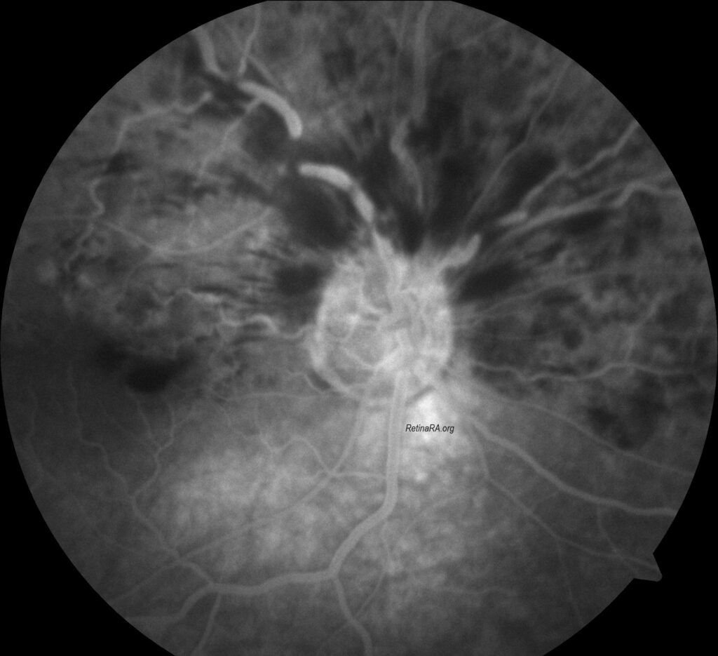 hemiretinal-vein-occlusion-2FF368tI