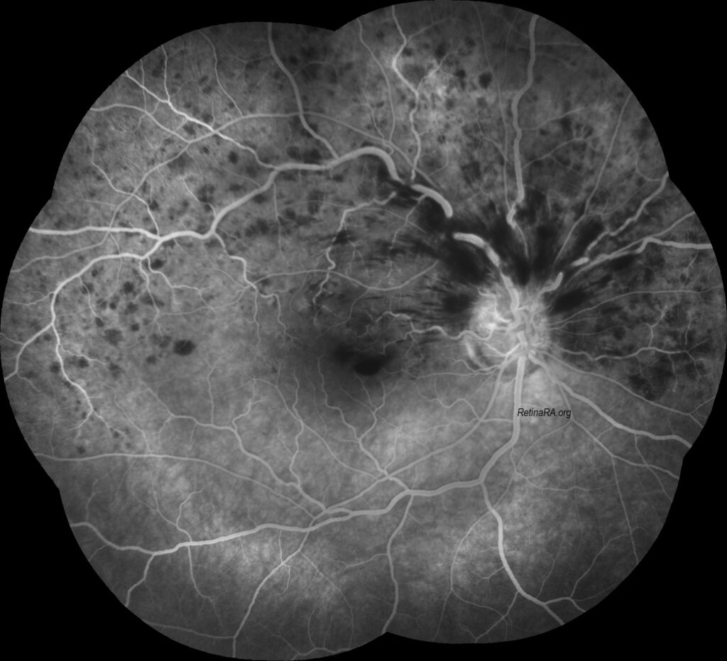 hemiretinal-vein-occlusion-37eysf3v