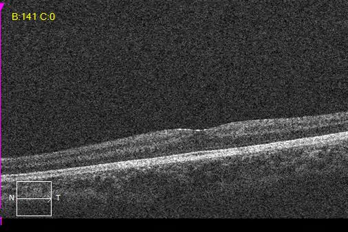 optik-nerve-hypoplasia-oct-od
