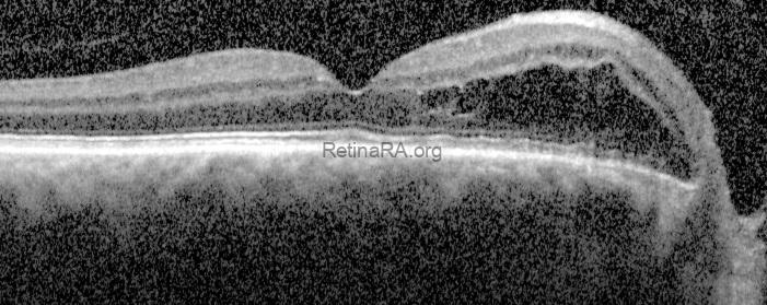 Normal Pachy Peripapillary Pachychoroid Syndrome - RetinaRA