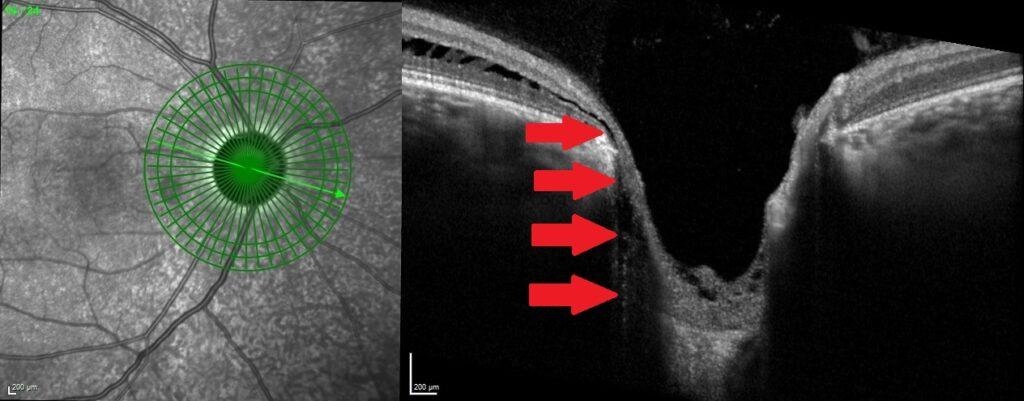 Acquired Optic Disc Pit Secondary to Glaucoma - RetinaRA