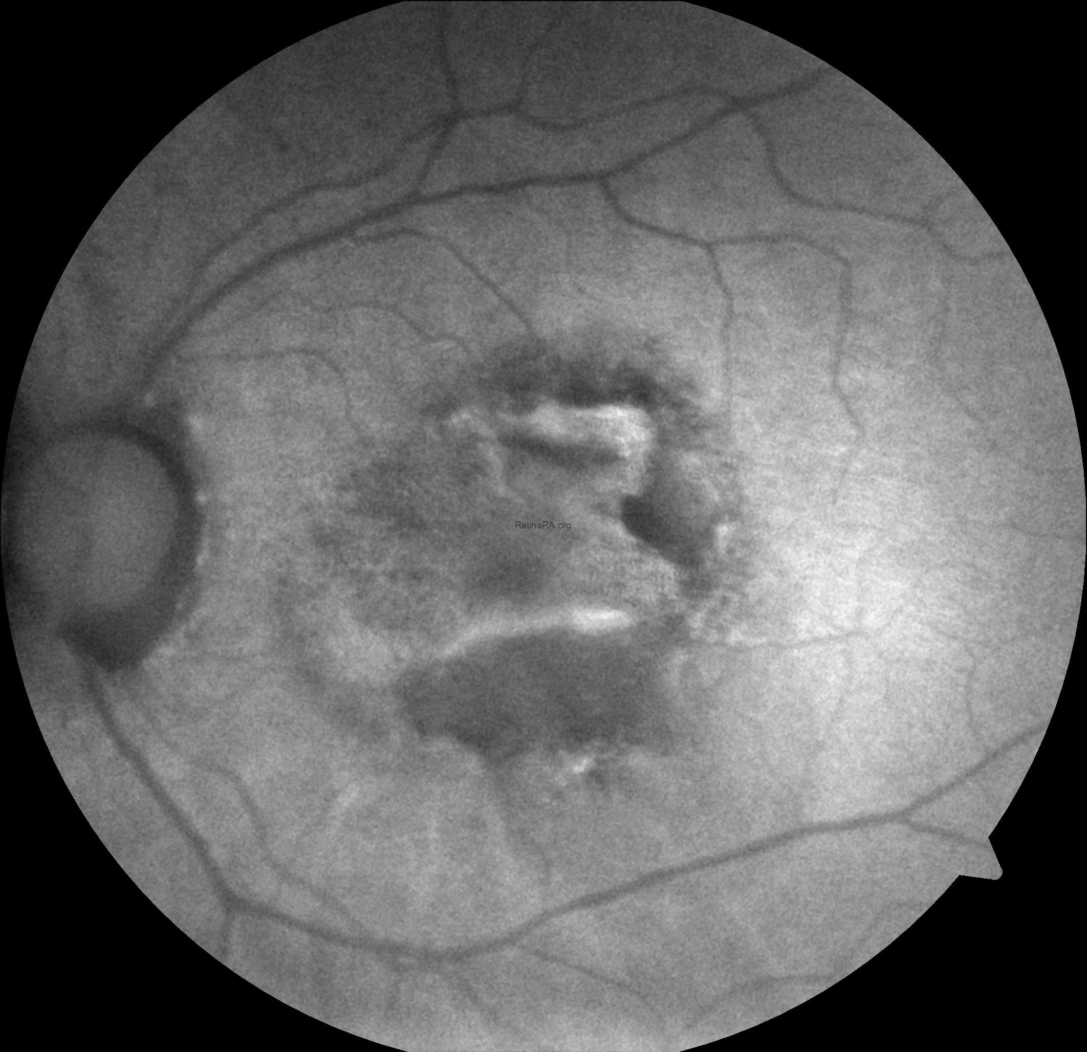 Type 1 Macular Neovascularization Complicated with RPE Tear and ...