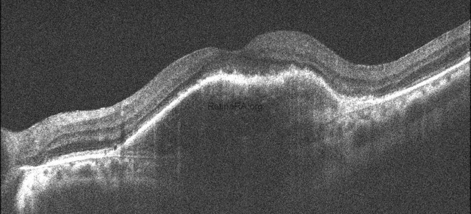 Type 1 Macular Neovascularization Complicated with RPE Tear and ...