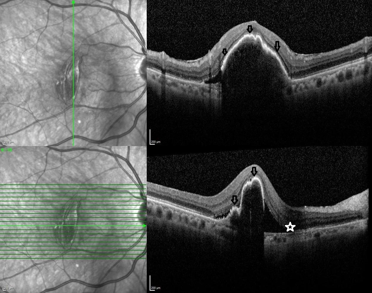 Retina Pigment Epithelial Tear - RetinaRA