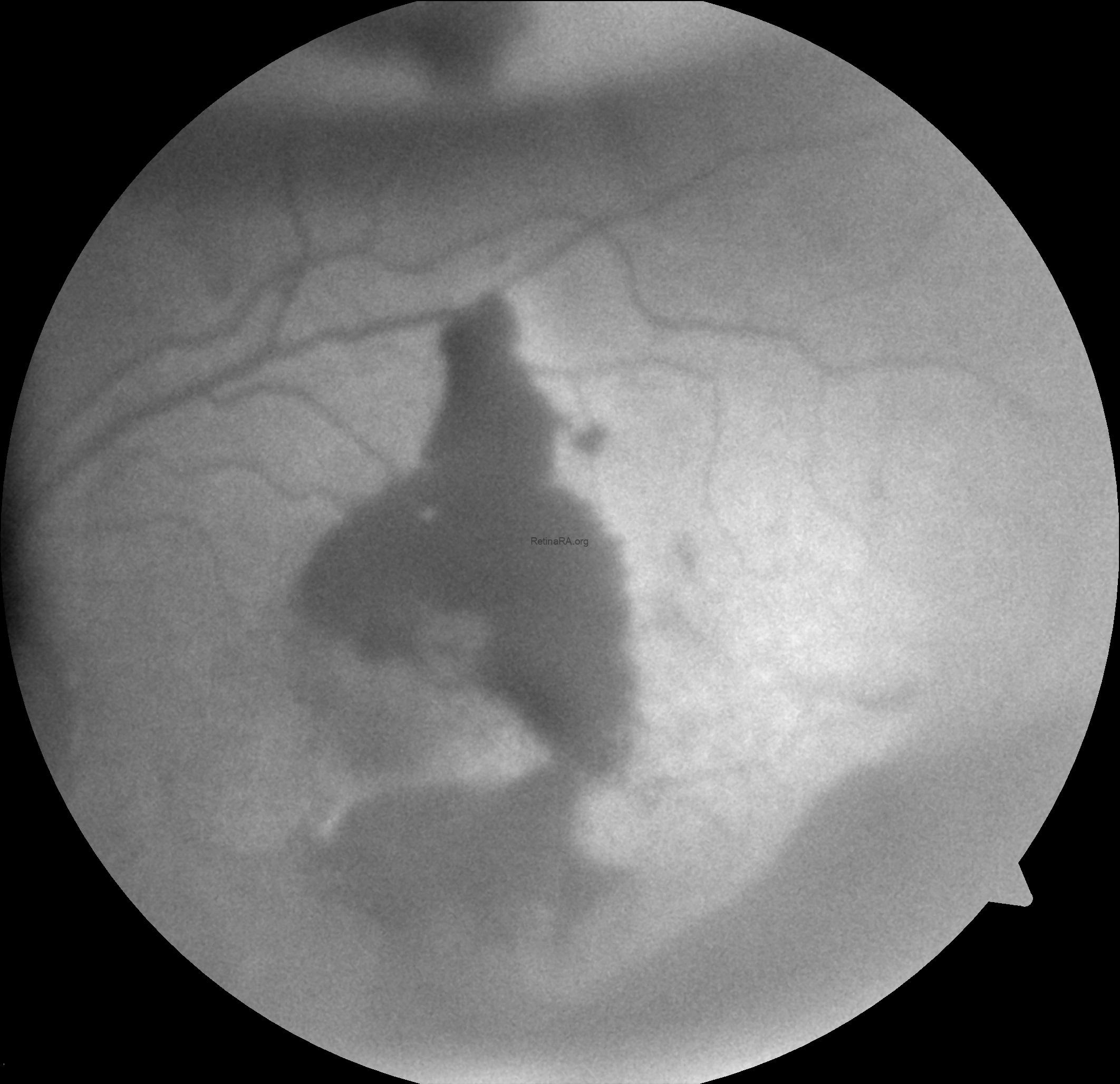 Type 1 Macular Neovascularization Complicated with RPE Tear and ...