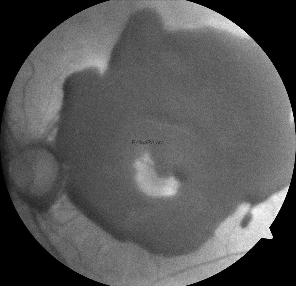Type 1 Macular Neovascularization Complicated with RPE Tear and ...