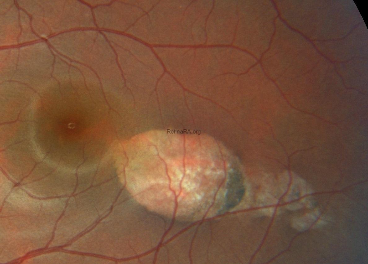 color-photography-torpedo-maculopathy-1-Kopya