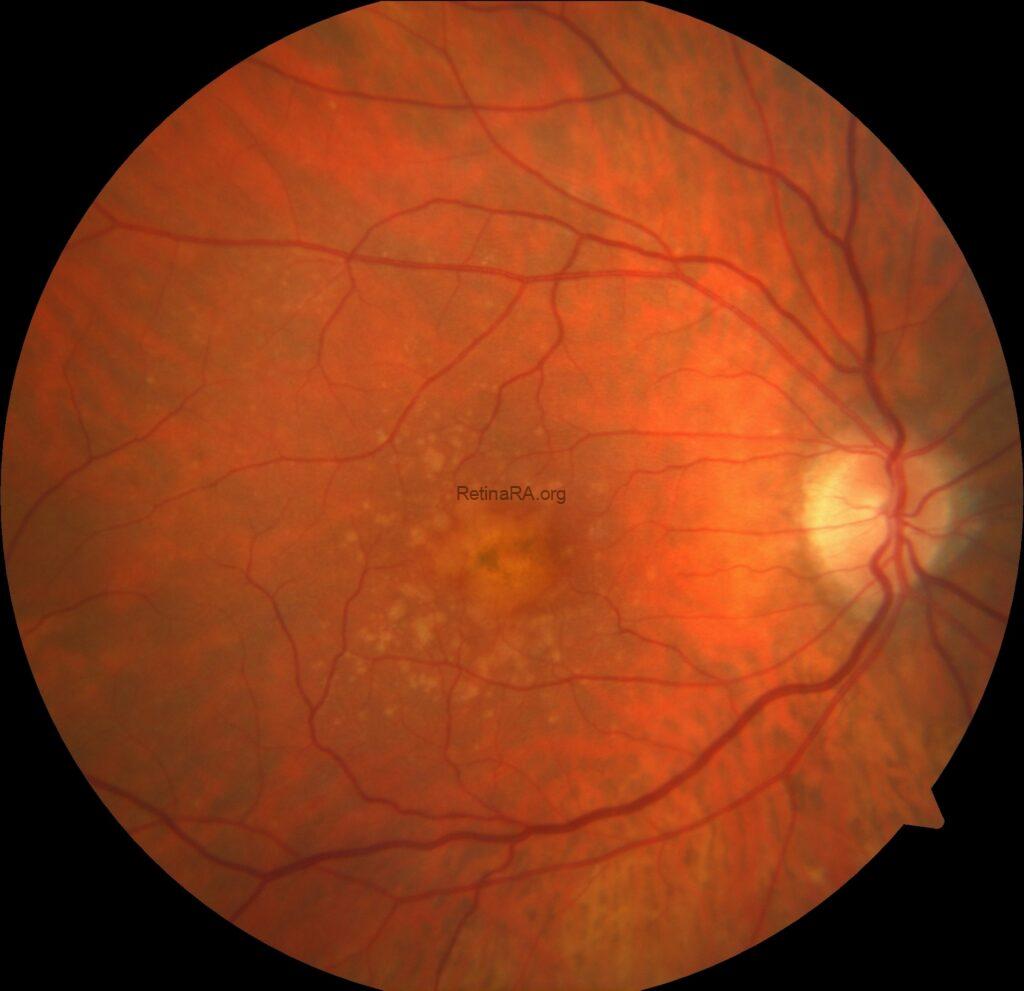 Drusenoid Pigment Epithelium Detachment - RetinaRA