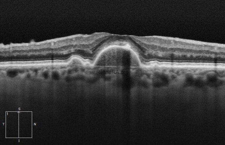 Drusenoid Pigment Epithelium Detachment - RetinaRA