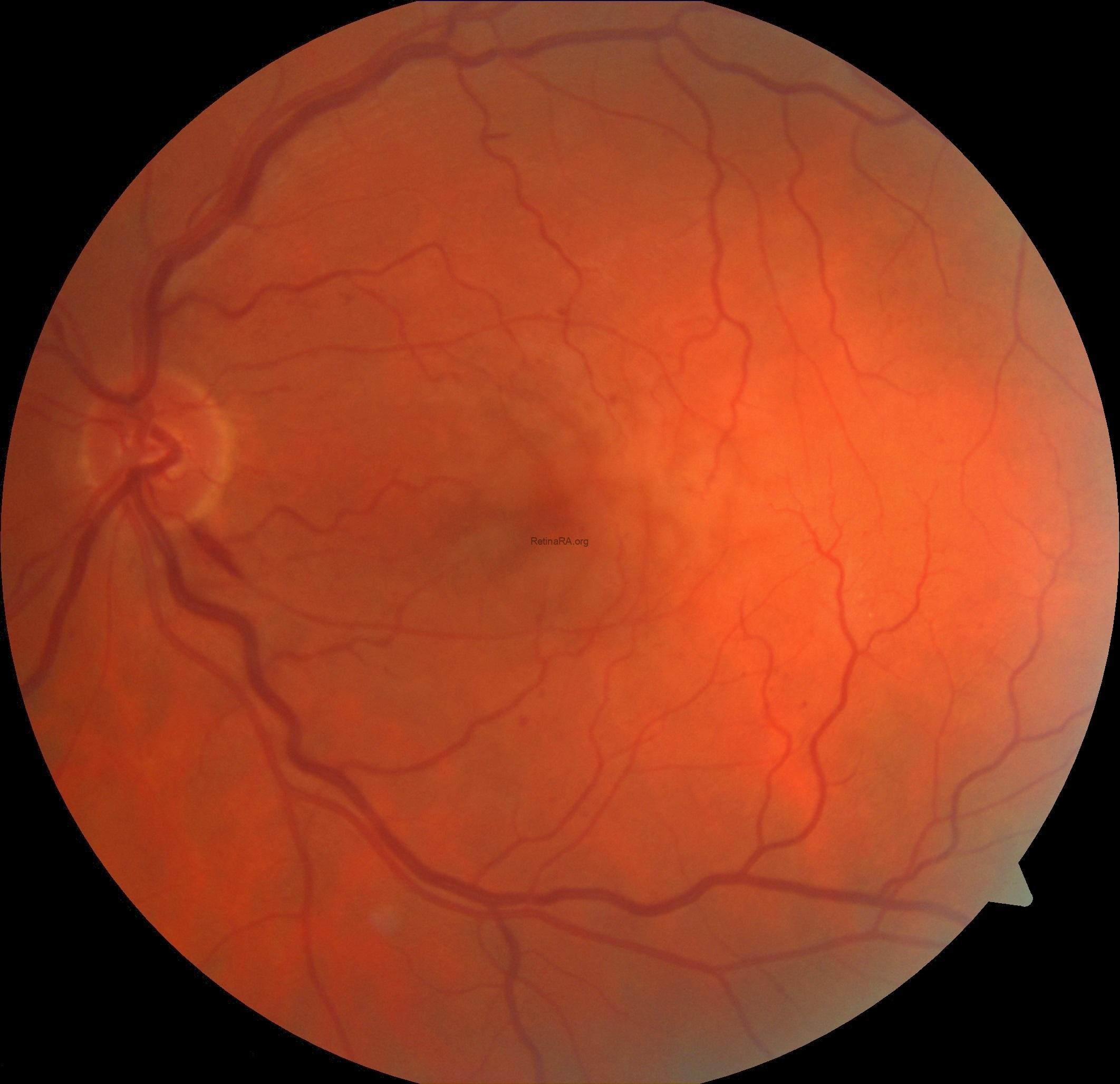 non-ischemic-crvo-pamm-6