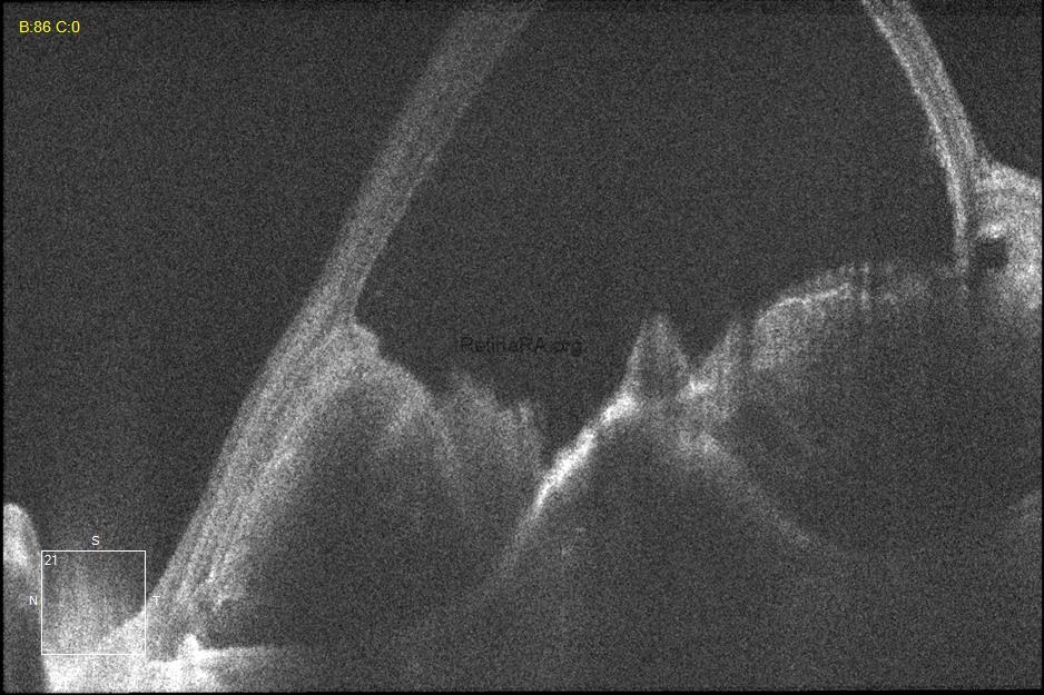 oct-of-submacular-hemorrhage