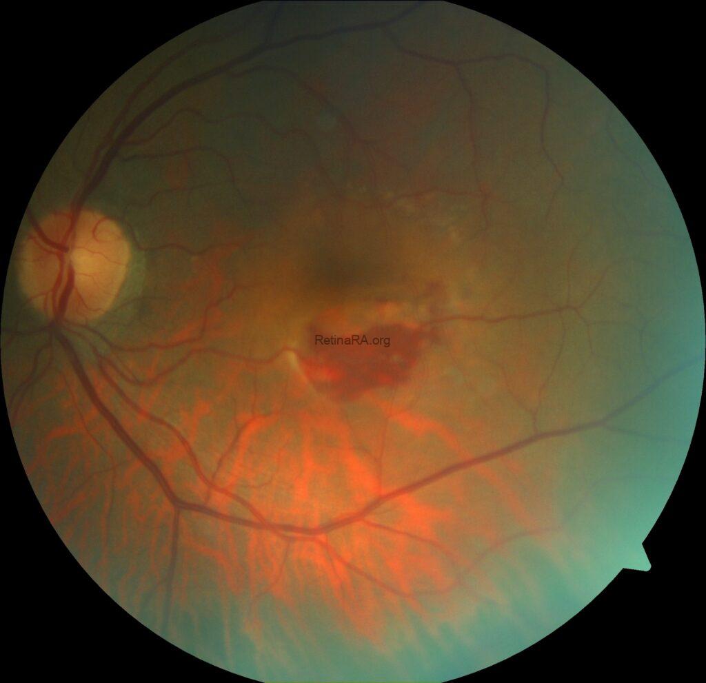 Type 1 Macular Neovascularization Complicated with RPE Tear and ...