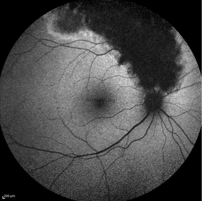 traumatic-pigmentary-retinopathy-BAF