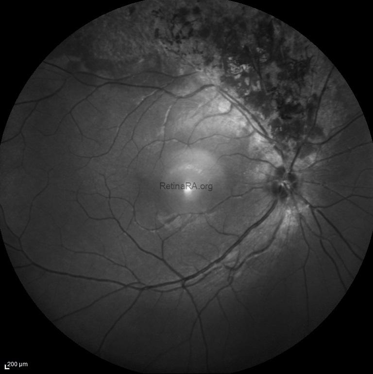traumatic-pigmentary-retinopathy-BR