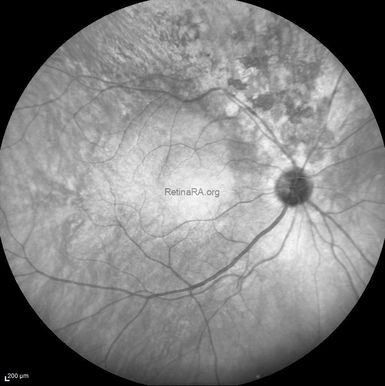 traumatic-pigmentary-retinopathy-IR