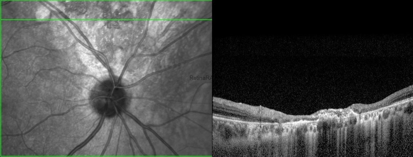 traumatic-pigmentary-retinopathy-OCTy1lW7WM