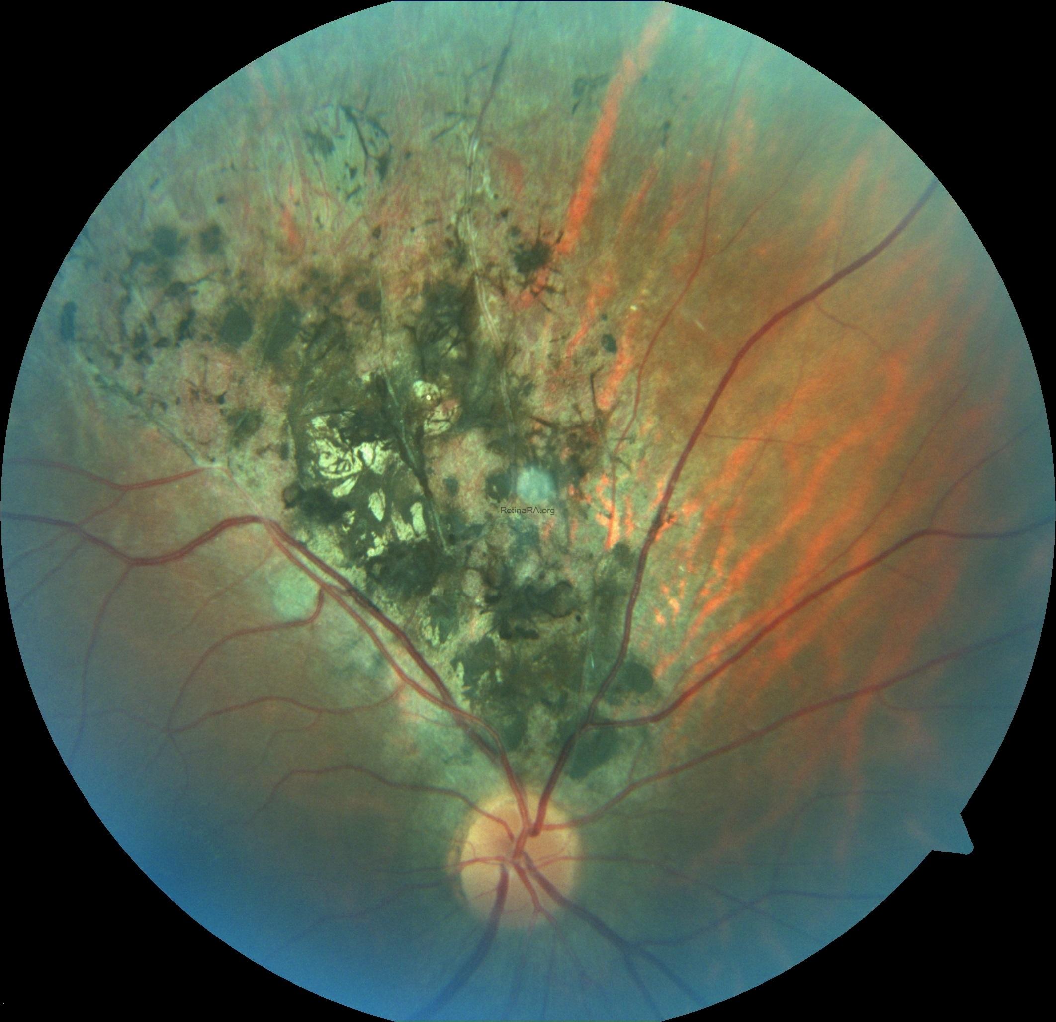 traumatic-pigmentary-retinopathy