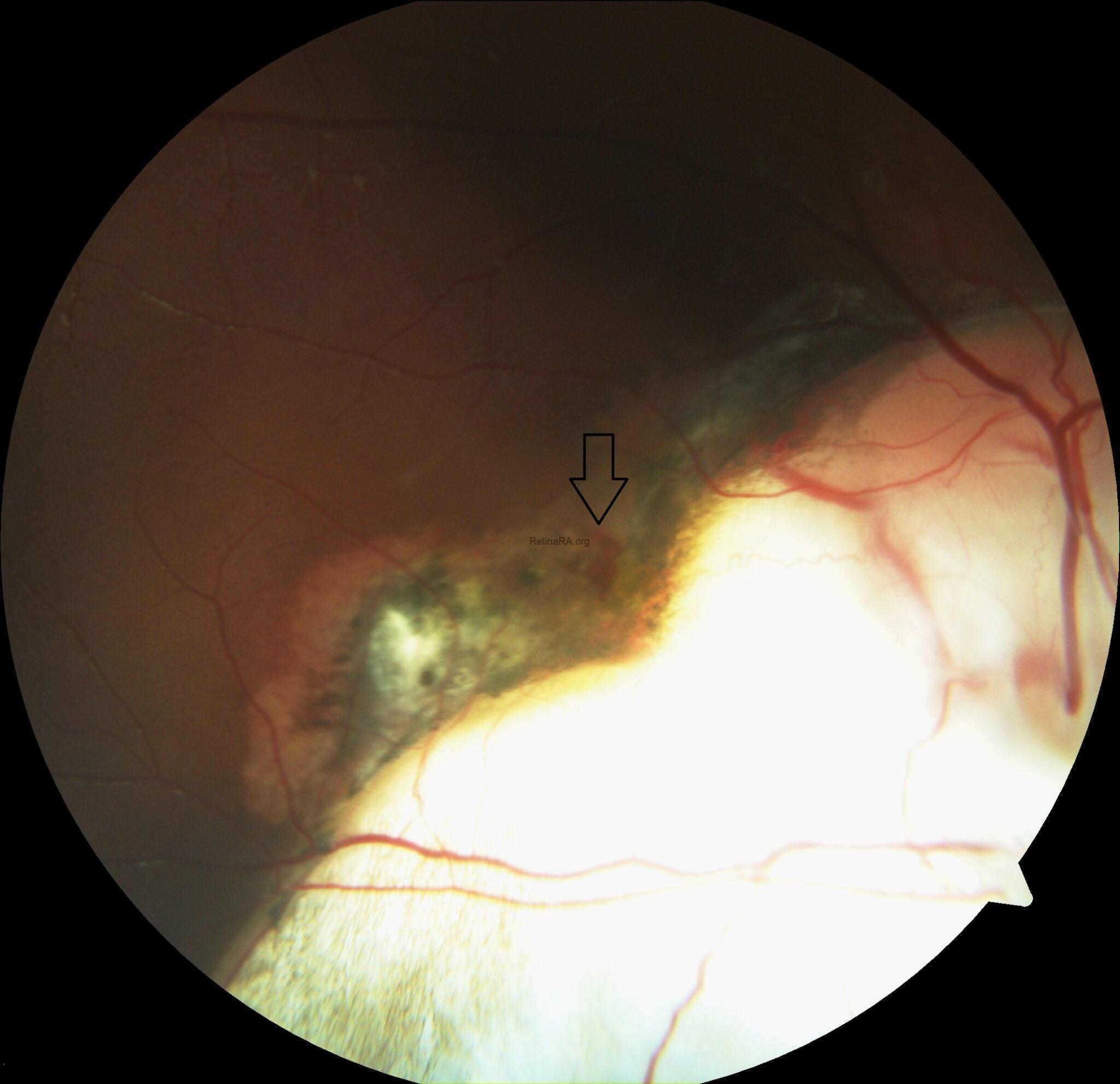 Choroidal Neovascularization Associated with Chorioretinal Coloboma ...
