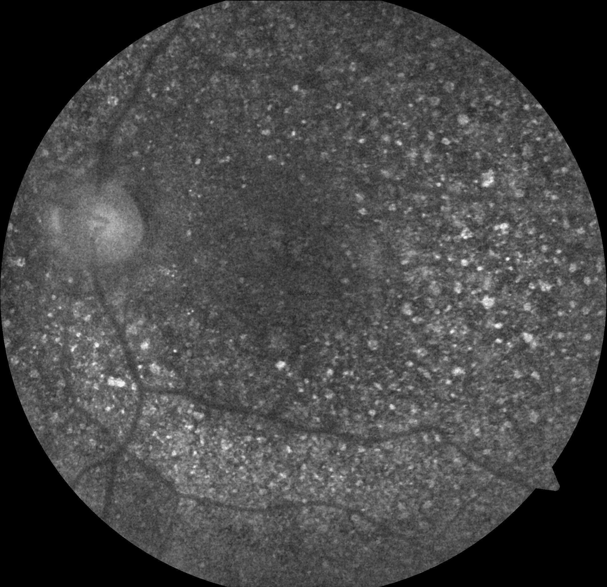 biettis-crysttalline-dystrophy-autofluorescence-image-1