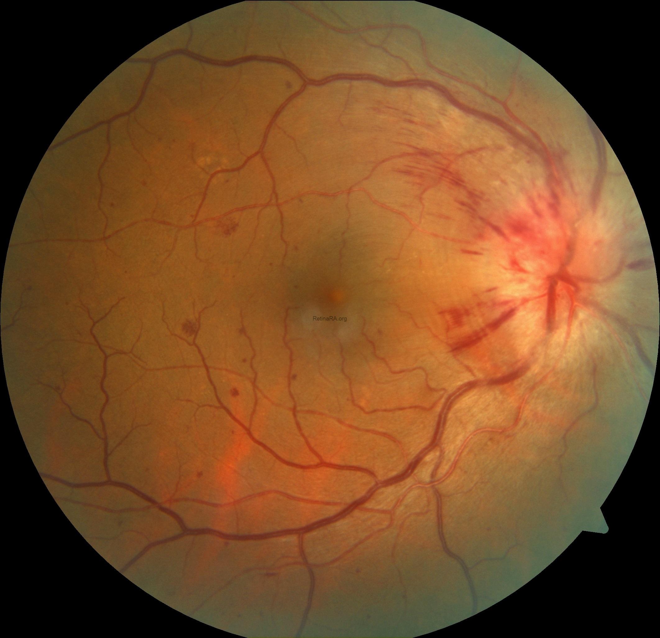hypertensive-retinopathy-color-fundus-photograph-2TLDYEl2