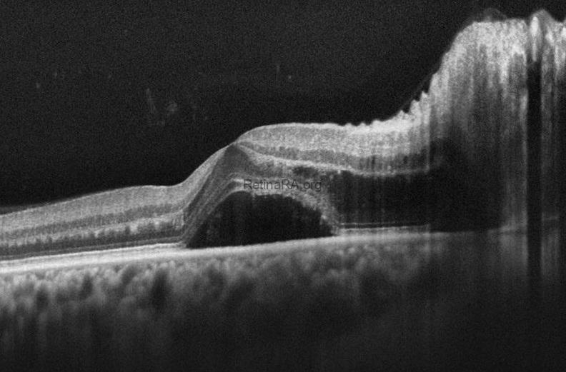 hypertensive-retinopathy-oct-1