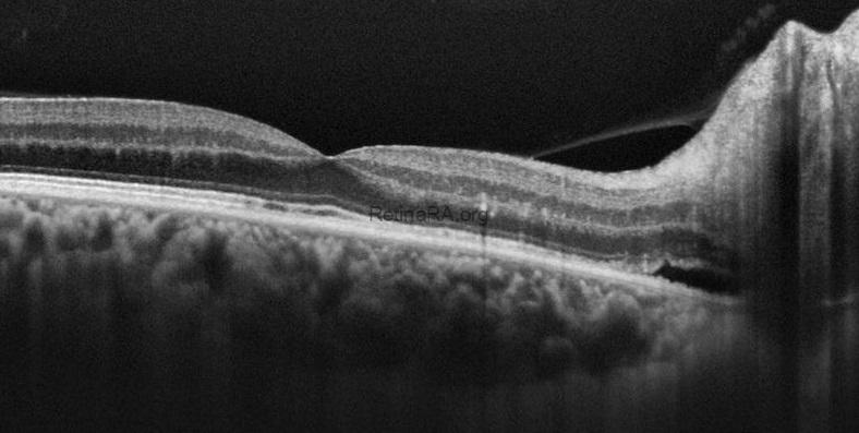 hypertensive-retinopathy-oct-2ejSKXl9