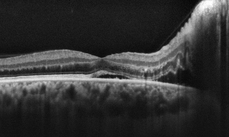 hypertensive-retinopathy-oct-3