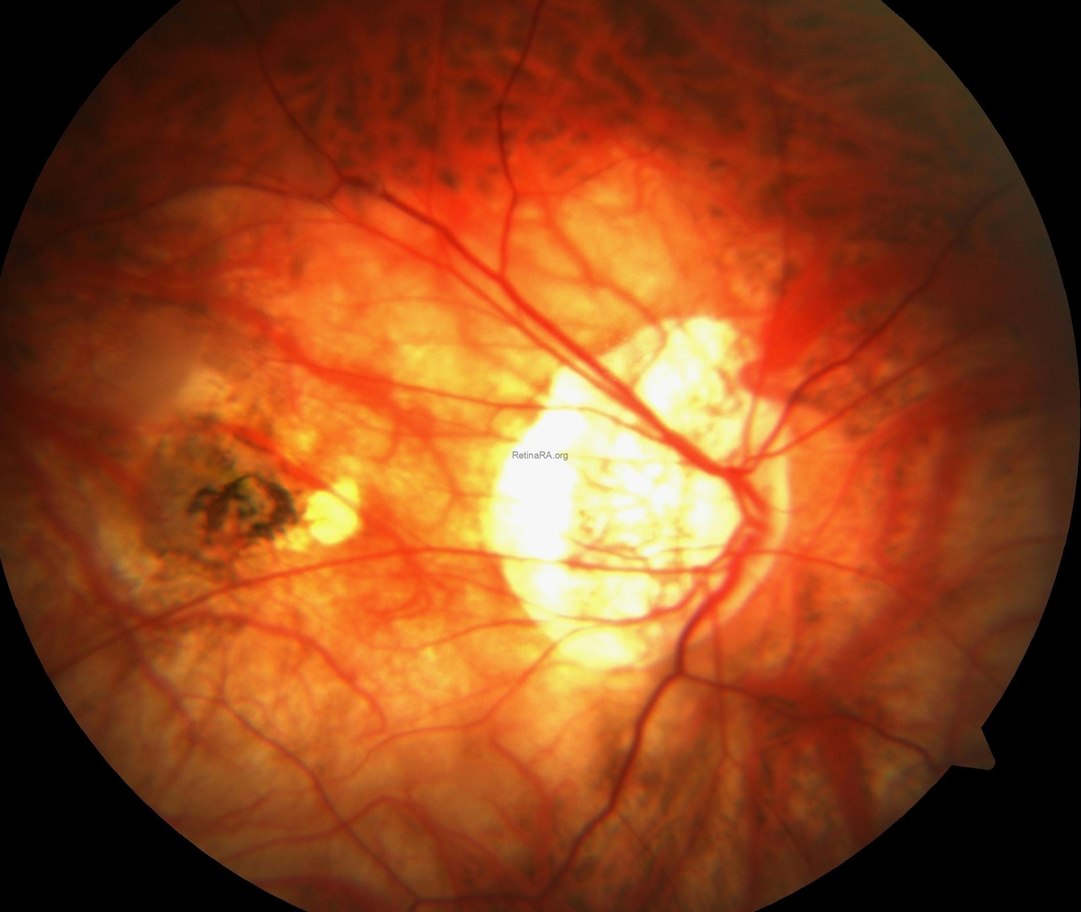 intrachoroidalcavitaition1