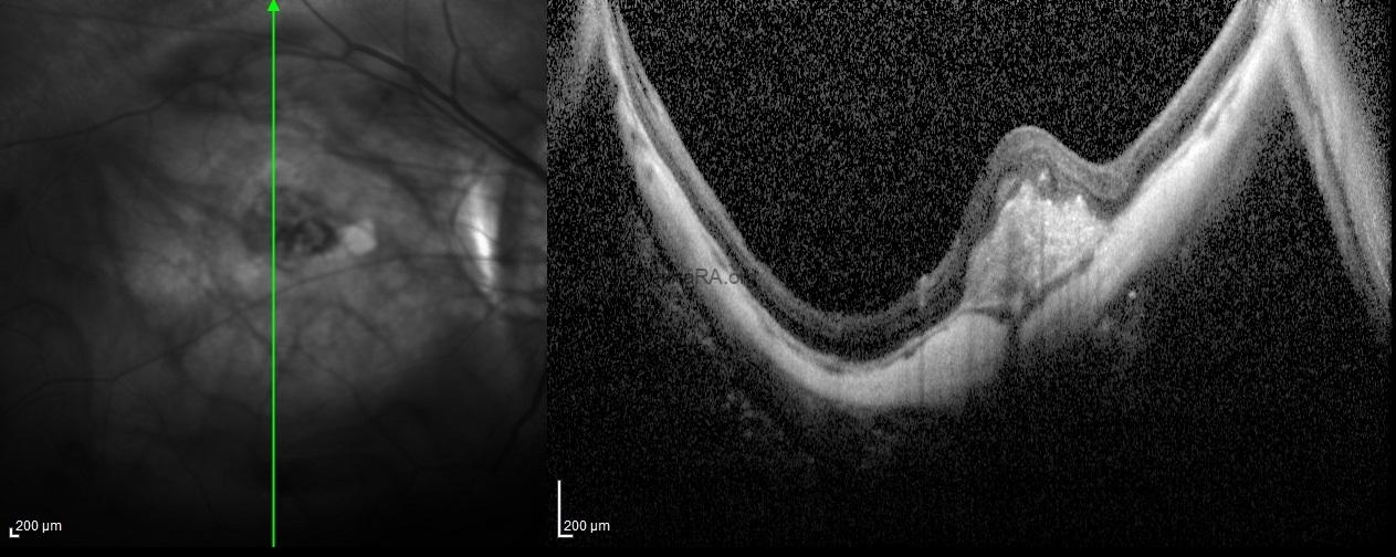 intrachoroidalcavitaiton3