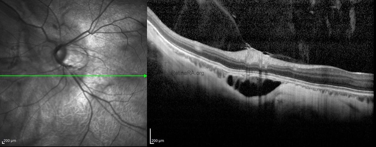 intrachoroidalcavitation4