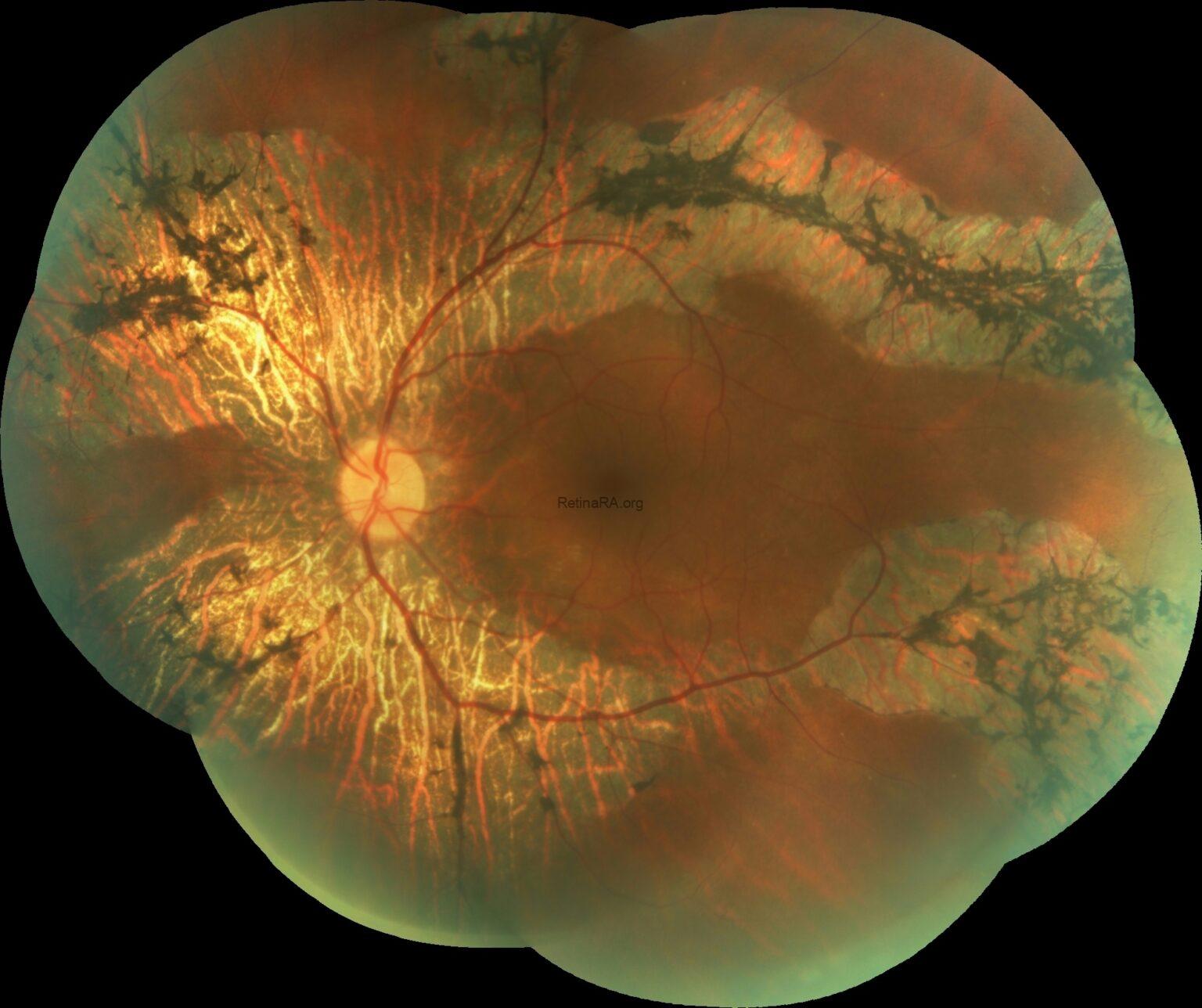 Pigmented Paravenous Retinochoroidal Atrophy - RetinaRA