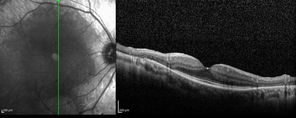 Pigmented Paravenous Retinochoroidal Atrophy - RetinaRA