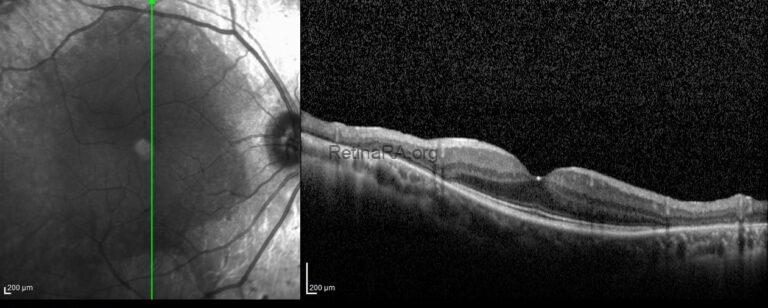 Pigmented Paravenous Retinochoroidal Atrophy - RetinaRA