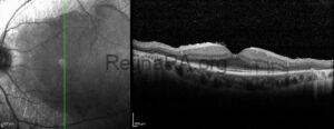 Pigmented Paravenous Retinochoroidal Atrophy - RetinaRA