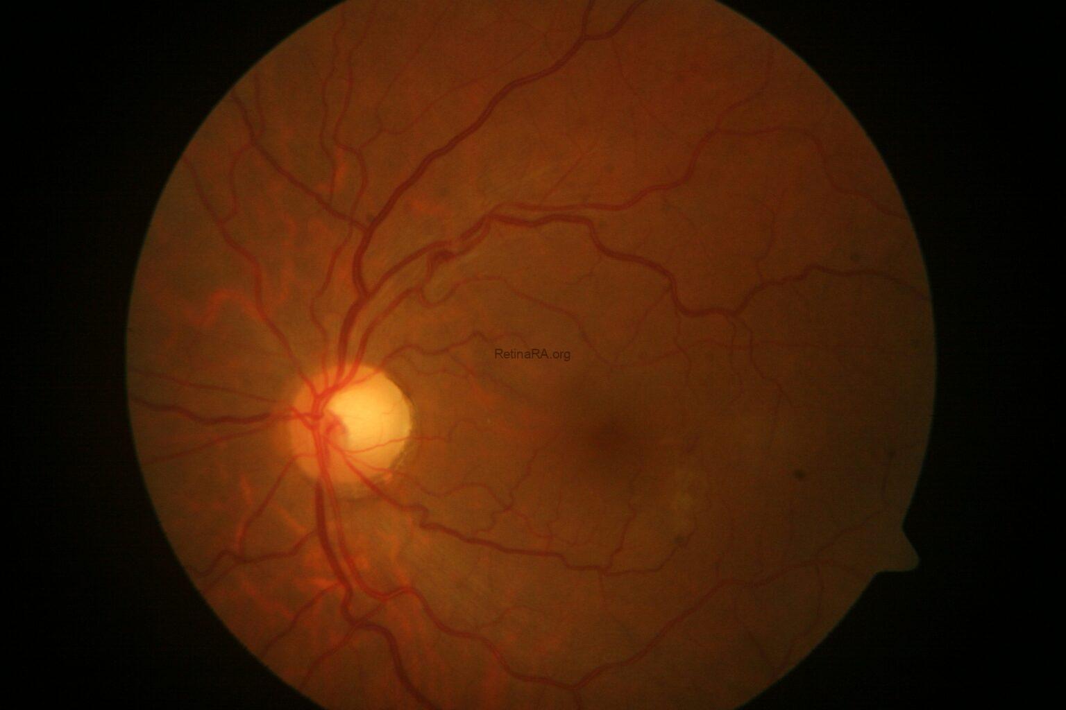 Subhyaloid Hemorrhage Secondary to Trauma - RetinaRA