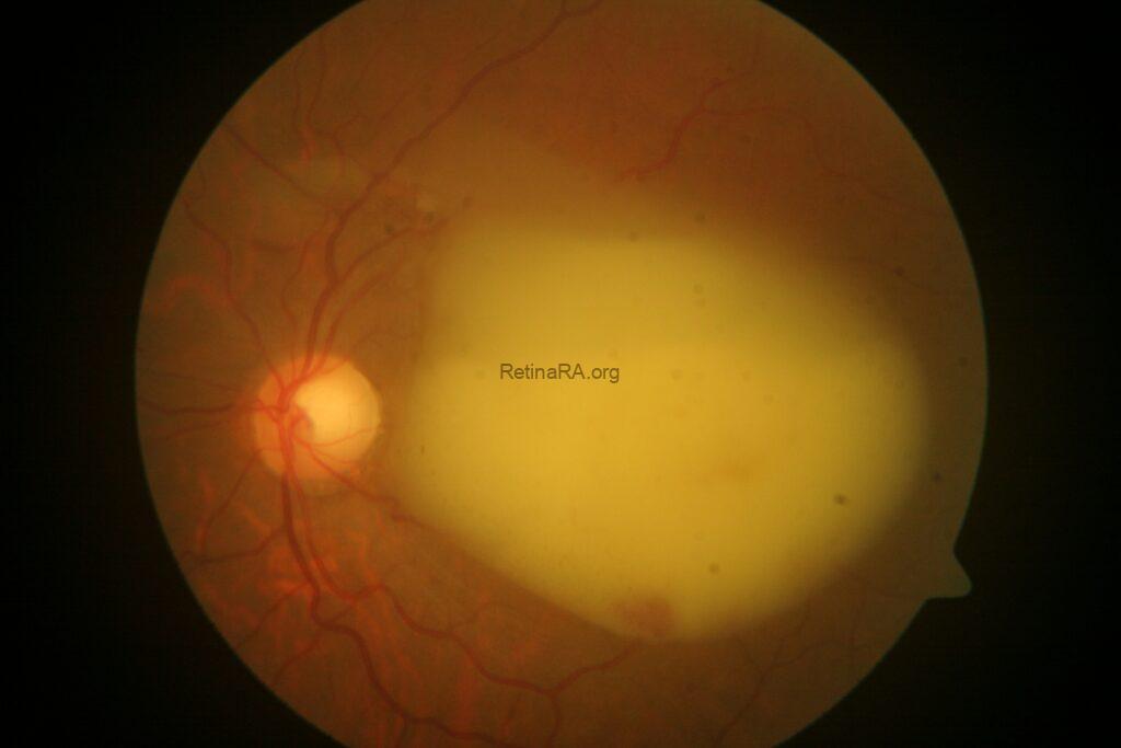 Fundus-Photo-Pre-Op0lZ9Fk5