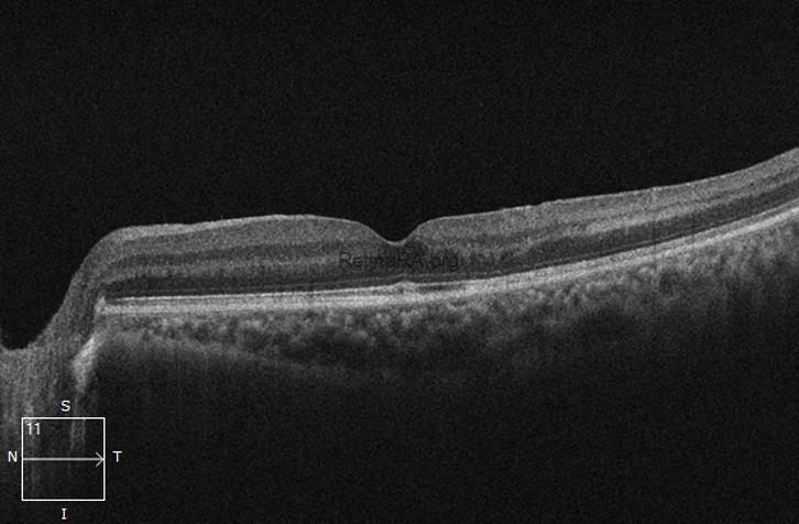 OCT-Scan-Post-op1mnrhRP