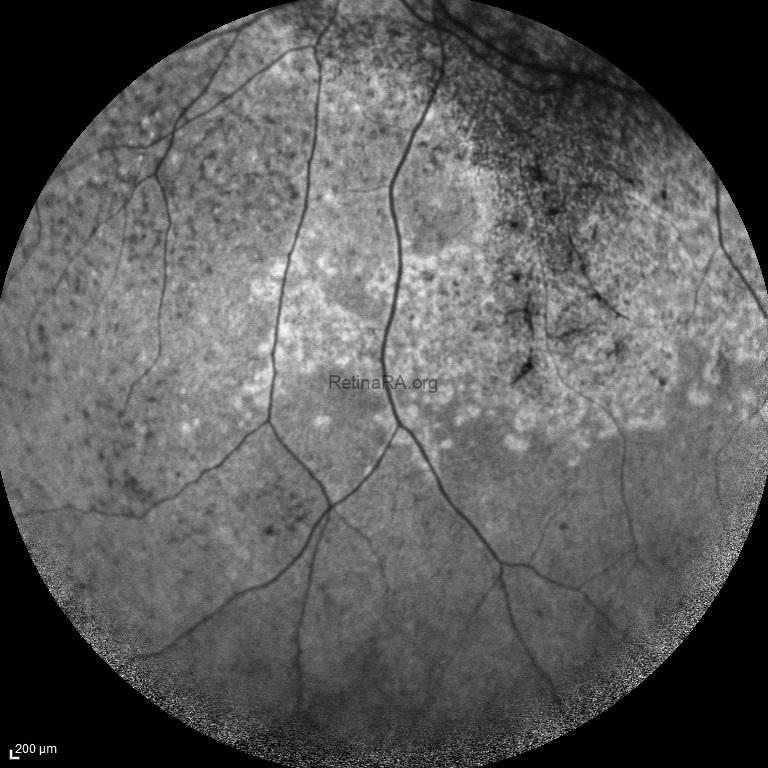 abca-4-retinopathy-autofluorescence-1