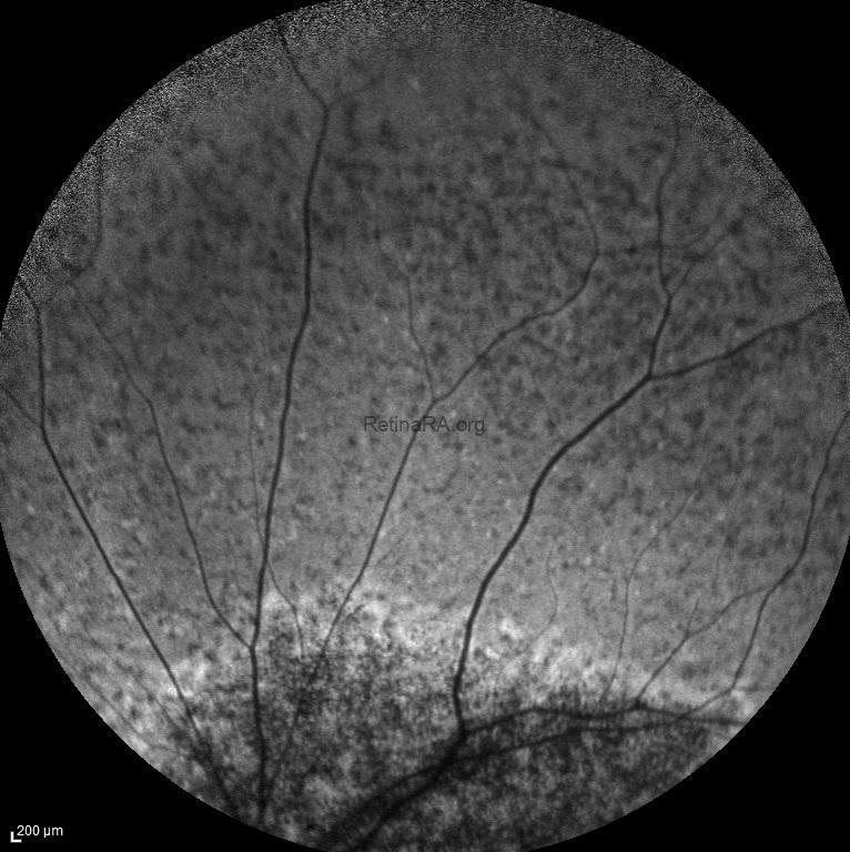 abca-4-retinopathy-autofluorescence-2