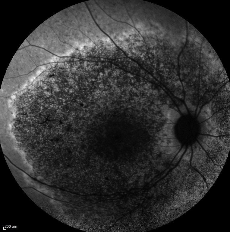 abca-4-retinopathy-autofluorescence-3DEPgw1d
