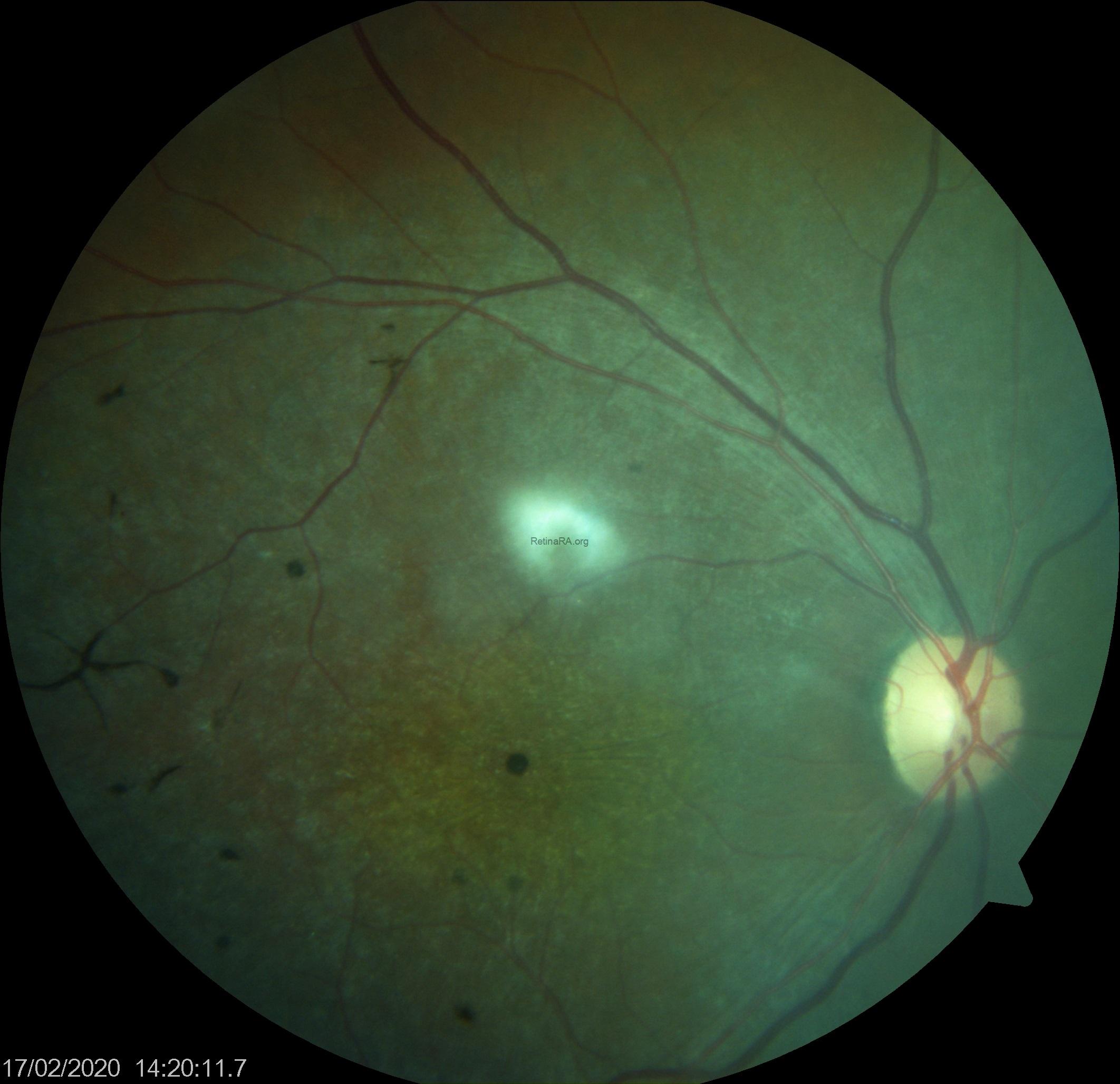 abca-4-retinopathy-color-photographhy-1
