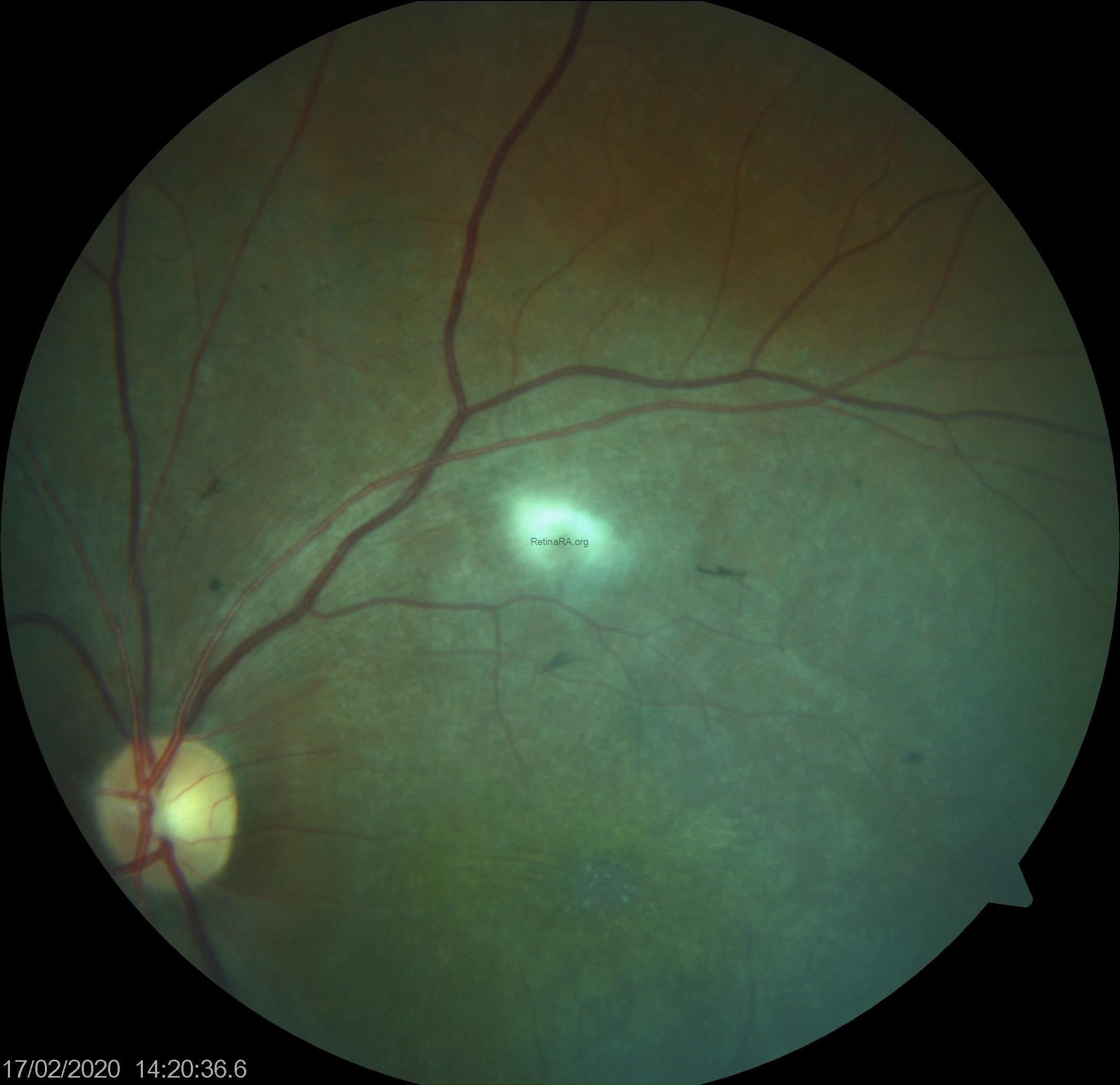 abca-4-retinopathy-color-photographhy-2