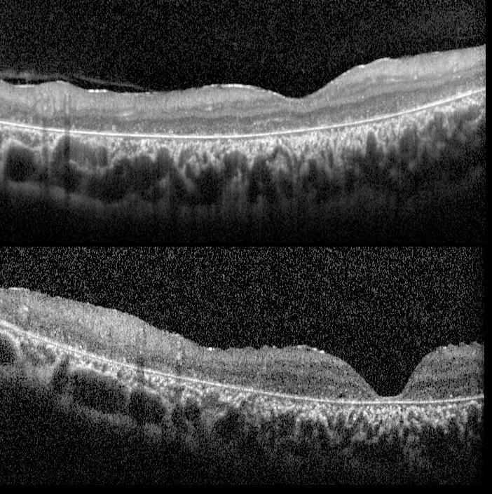 abca-4-retinopathy-oct