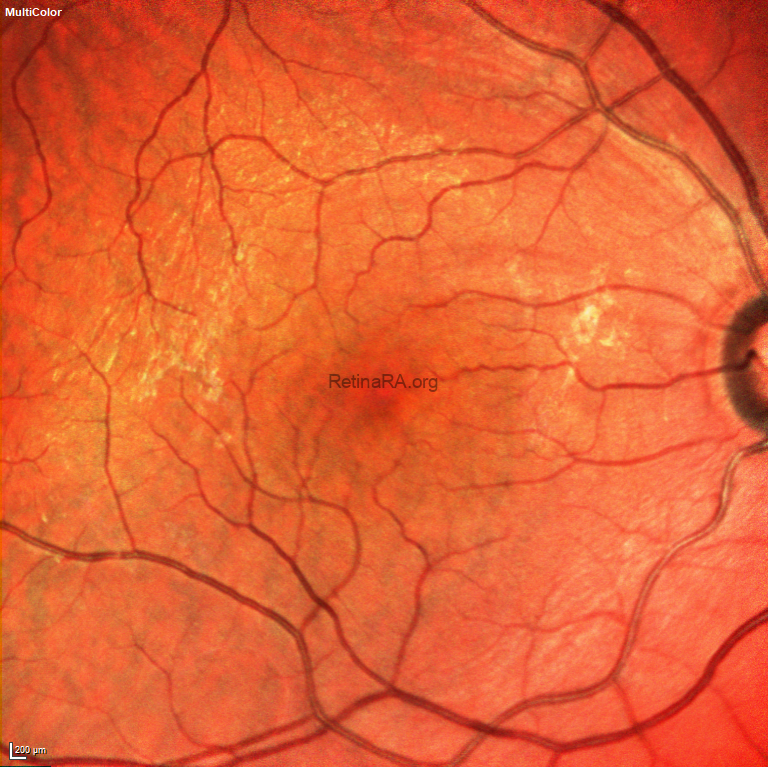 macular-hole-POSTOP-multicolor